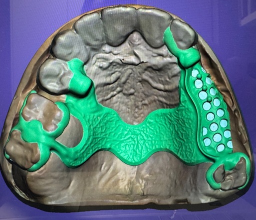 Partial denture - CadCam Masters