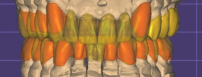 Crown and bridge - CadCam Masters