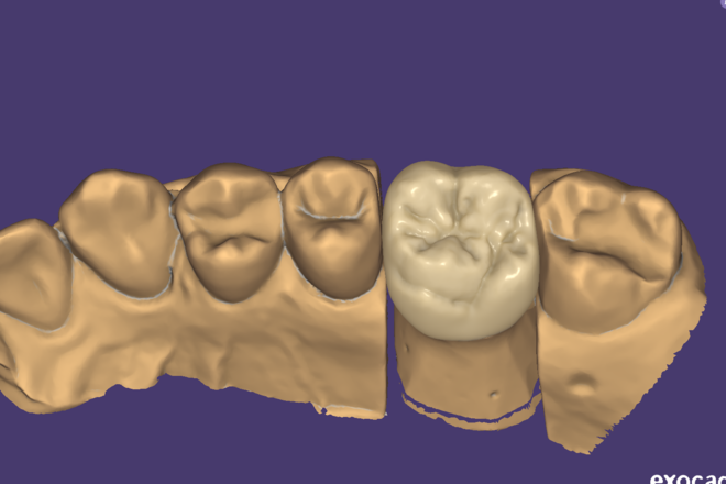 Design Crown - CadCam Masters
