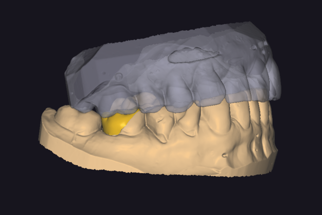 Onlays and Inlays - CadCam Masters
