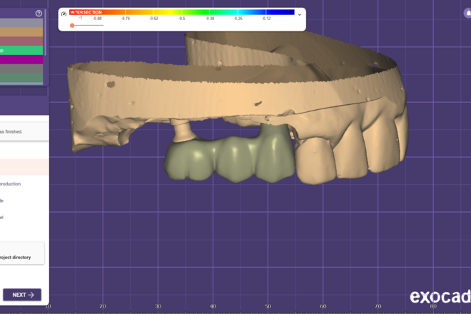 Implant Crown and Bridge - CadCam Masters