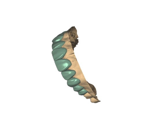 Veneers Design