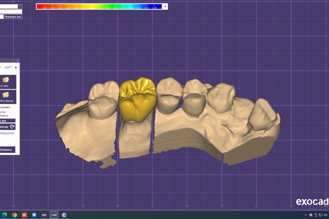 3D Dental CAD Design in Exocad for Labs & Clinics