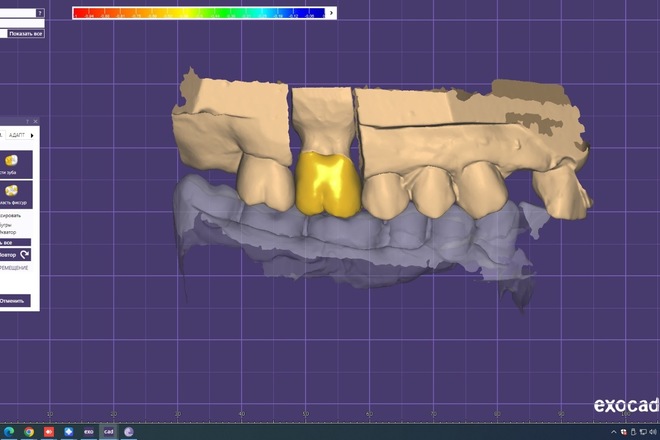 3D Dental CAD Design in Exocad for Labs & Clinics