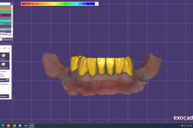 3D Dental CAD Design in Exocad for Labs & Clinics