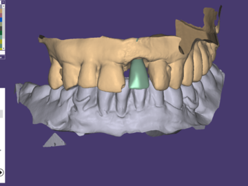 Dental Cad-Service: Implants Crowns with reduction
