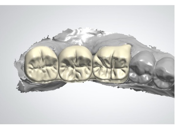 Dental Cad-Service: Bridges 