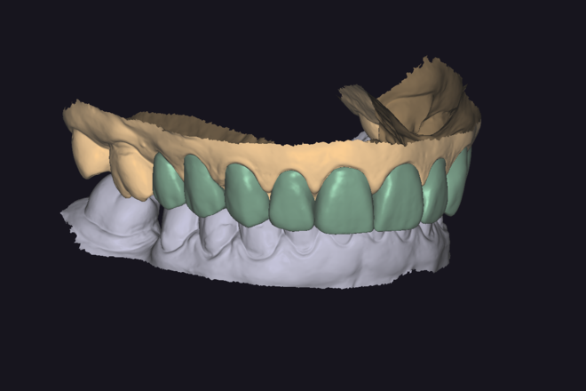 Veneers (Unities)