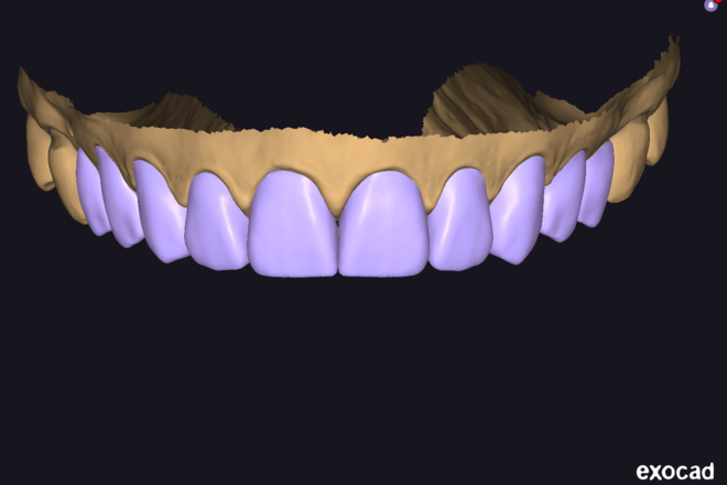 Veneers (Unities)