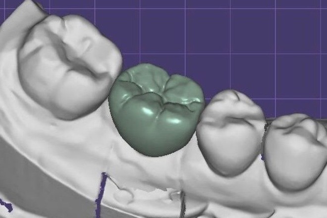 Implant - CadCam Masters
