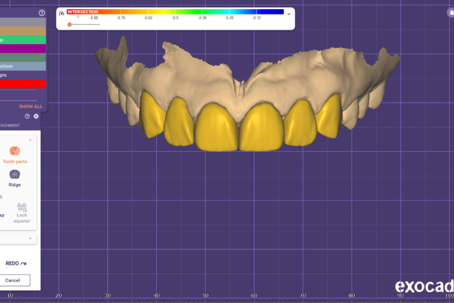 premium quality veneers - CadCam Masters