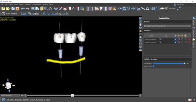 Tooth supported guide and implant planning