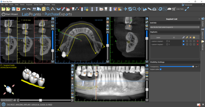 Tooth supported guide and implant planning