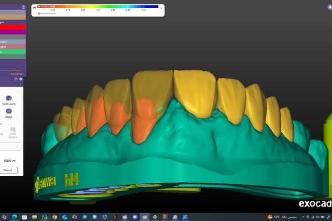 Professional Exocad Dental Designer