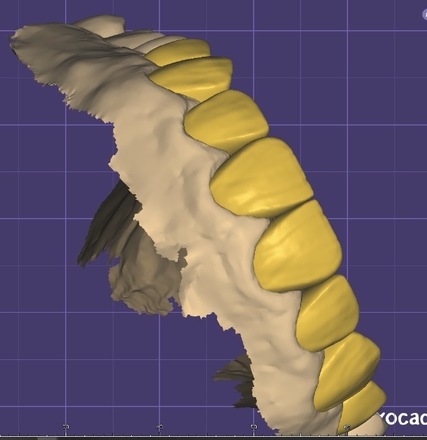 Professional Exocad Dental Designer