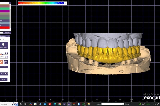 Professional Exocad Dental Designer