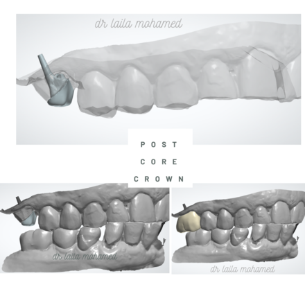 post, core and crown