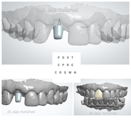 post, core and crown