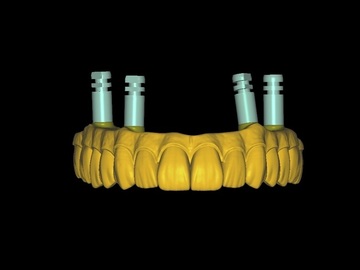 Dental Cad Service: Full arch over implants
