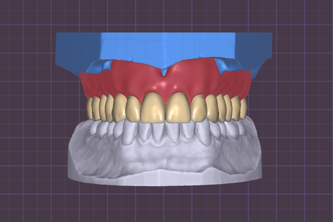 Full Upper Denture - CadCam Masters