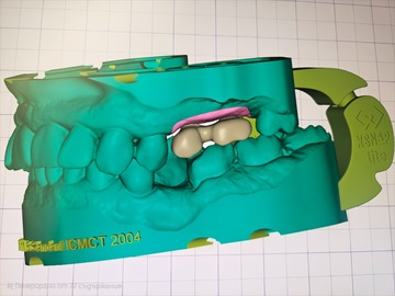 Dental Cad Service: Dental Exocad design from Intraoral scans using Scan bodies