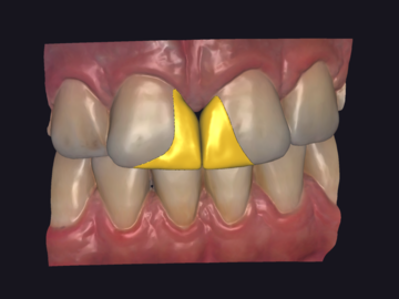 Dental Cad Service: Professional Exocad Designer for Crowns, Veneers & Bridges