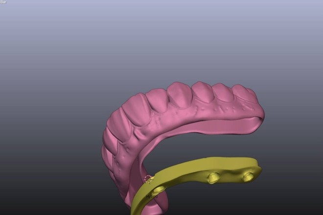 Implant Bar with All on X on it
