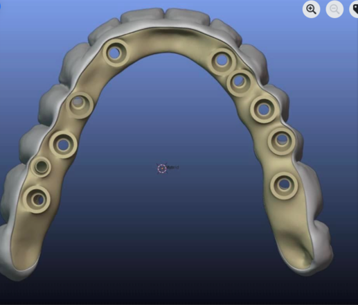Implant Bar with All on X on it