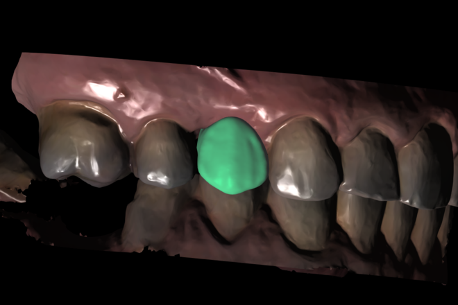 Crowns/Bridge/inlay