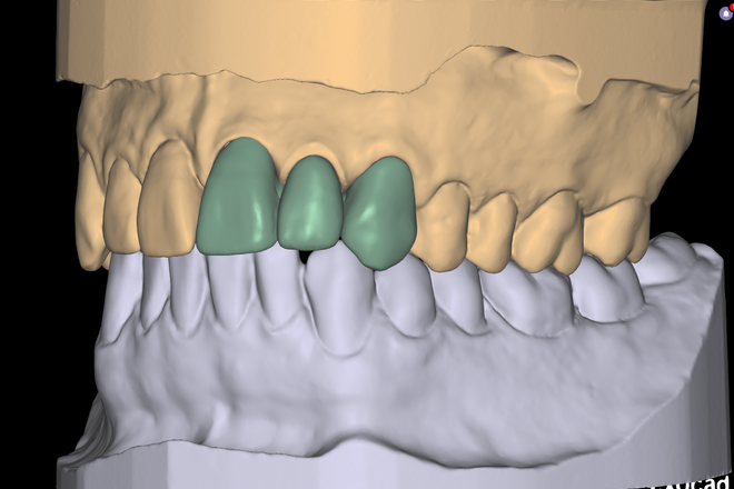 Crowns/Bridge/inlay