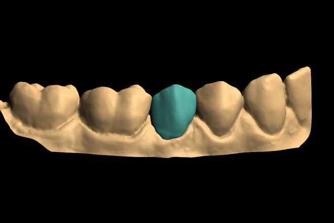 Crowns/Bridge/inlay