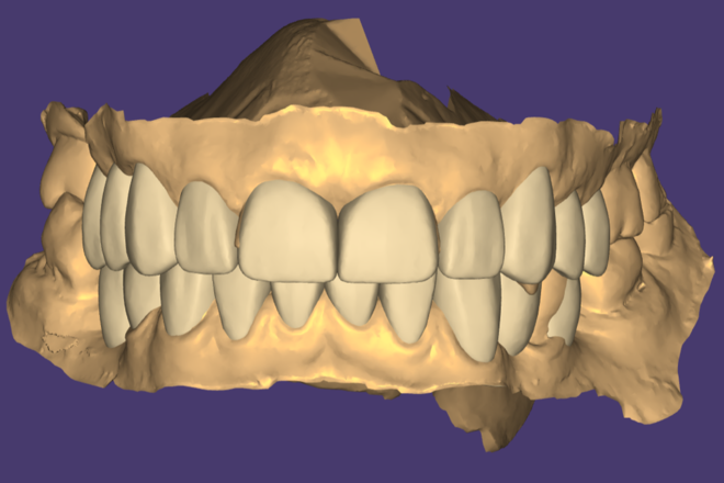 Digital Wax Up