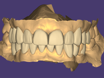 Service de Cad Dentaire: Digital Wax Up