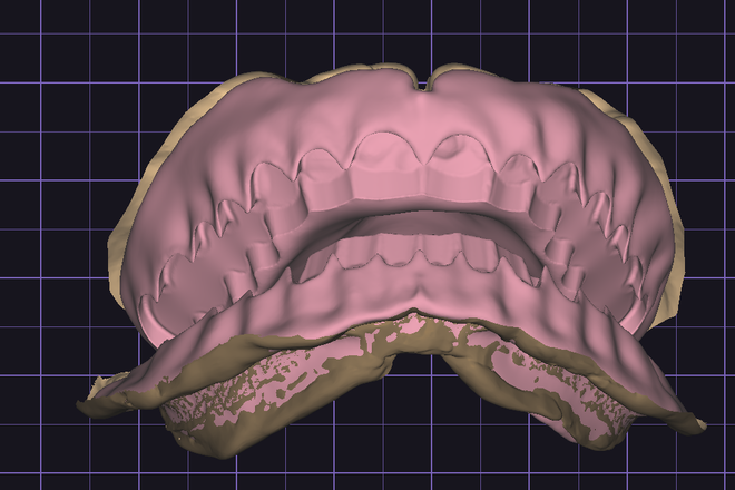 FULL DENTURE