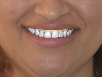 Dental Cad-Service: Digital Smile Design