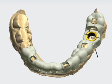 Serviço de Cad Dental: SURGICAL GUIDE