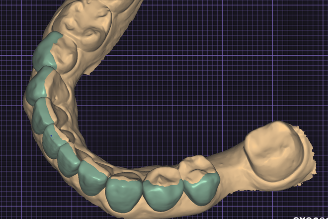 WAX-UP DIGITAL ( MOK-UP OR INJECTION MOULDING STENT)