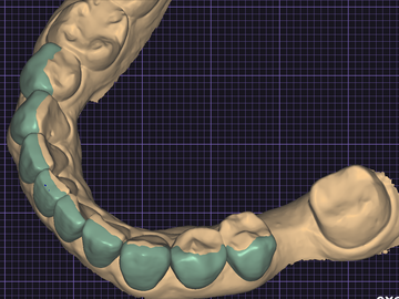 Service de Cad Dentaire: WAX-UP DIGITAL ( MOK-UP OR INJECTION MOULDING STENT)