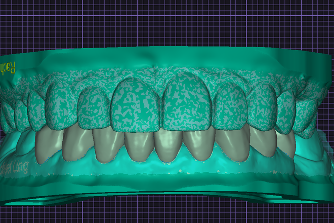 WAX-UP DIGITAL ( MOK-UP OR INJECTION MOULDING STENT)