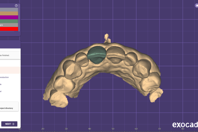Crown and bridge 