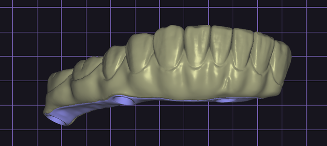 Design Full Arch combine I-Bar (exocad)