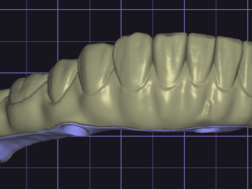 Servicio de Cad Dental: Design Full Arch combine I-Bar (exocad)