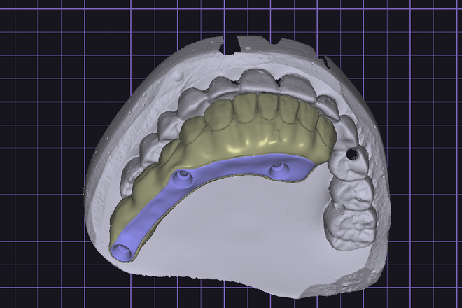 Design Full Arch combine I-Bar (exocad)