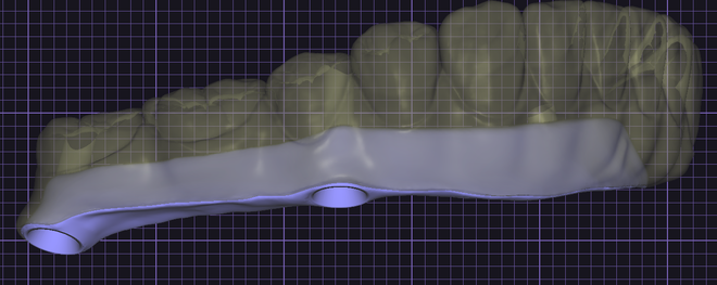 Design Full Arch combine I-Bar (exocad)