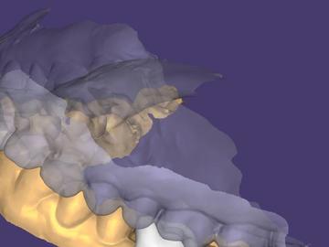 Servicio de Cad Dental: Crown and Bridge Design