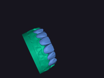 Servicio de Cad Dental: FACET DESIGNS