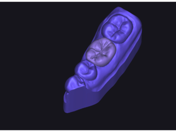 Servicio de Cad Dental: Onlay/Inlay