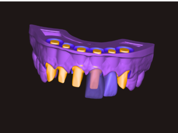 Servicio de Cad Dental: Tooth-Supported and Implant-Supported Crowns
