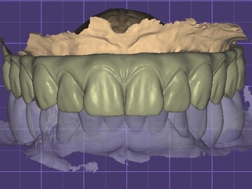 Dental Cad-Service: Full-arch/ immediate design