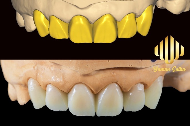 UPPER ANTERIOR CASE